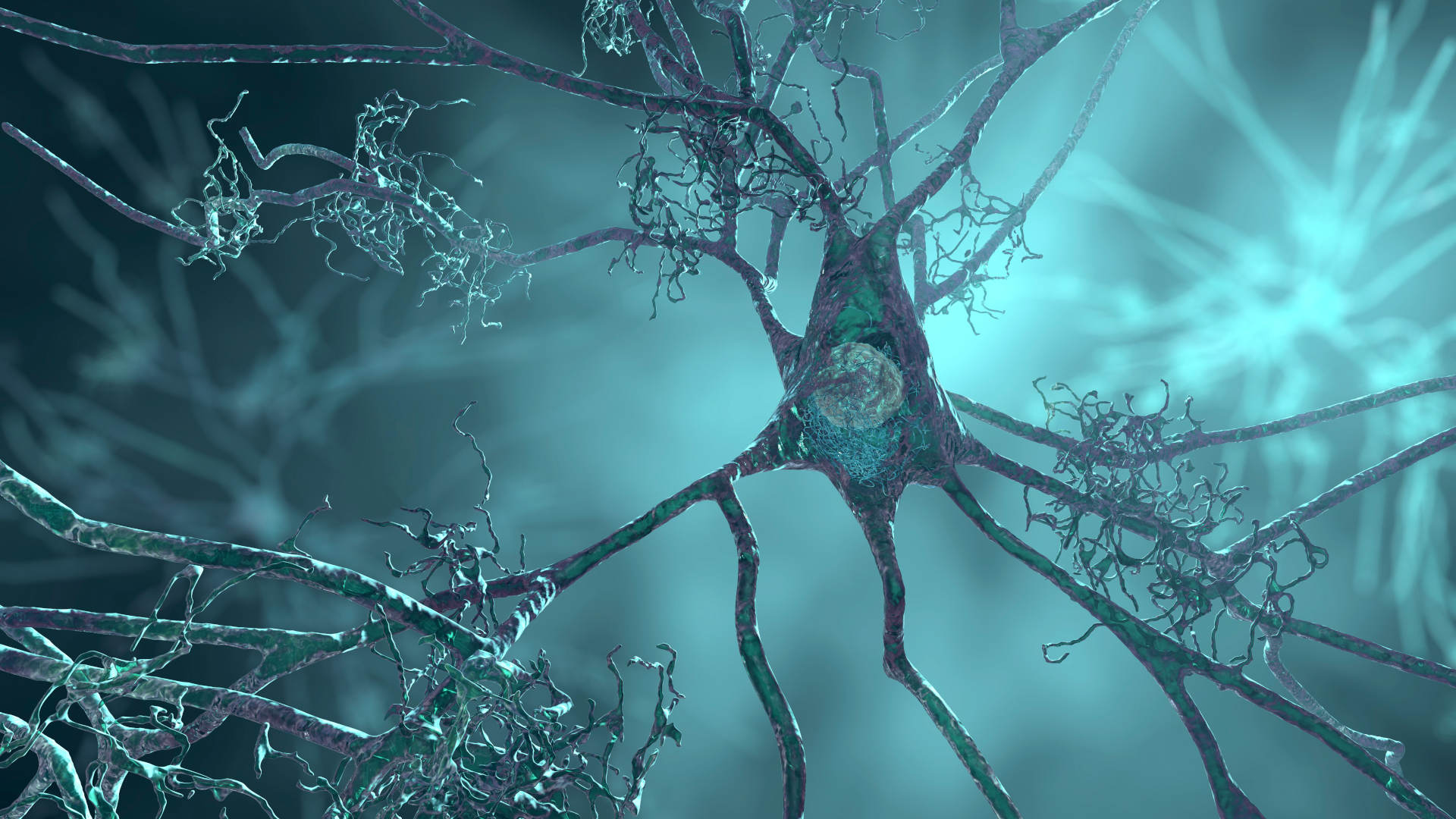 An illustration of amyloid plaques, a characteristic feature of Alzheimer's disease, amongst neurons.